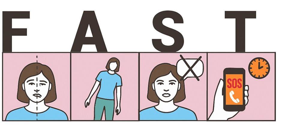 Eine Illustration zeigt die vier Merkmale des FAST-Tests zur Erkennung eines Schlaganfalls.